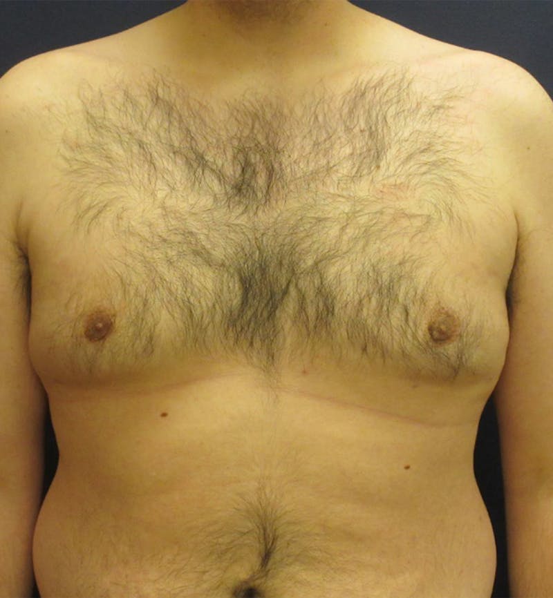 Male Breast Reduction Before & After Gallery - Patient 175226 - Image 2