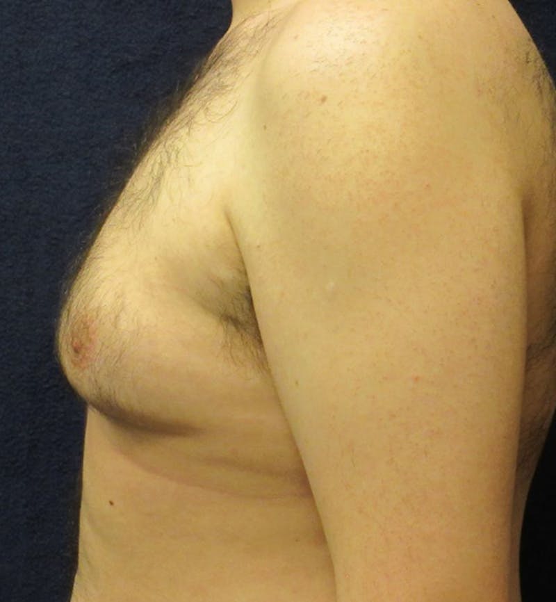 Male Breast Reduction Before & After Gallery - Patient 175226 - Image 3