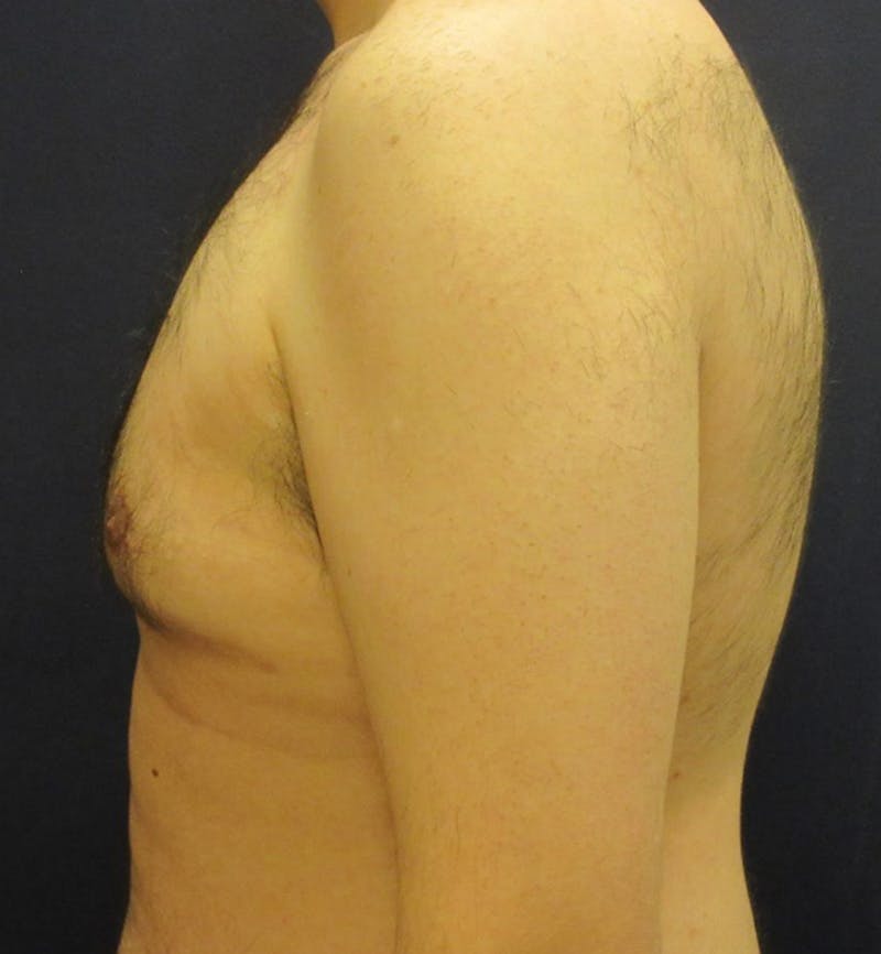 Male Breast Reduction Before & After Gallery - Patient 175226 - Image 4