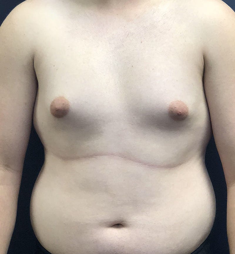 Male Breast Reduction Before & After Gallery - Patient 187852 - Image 1