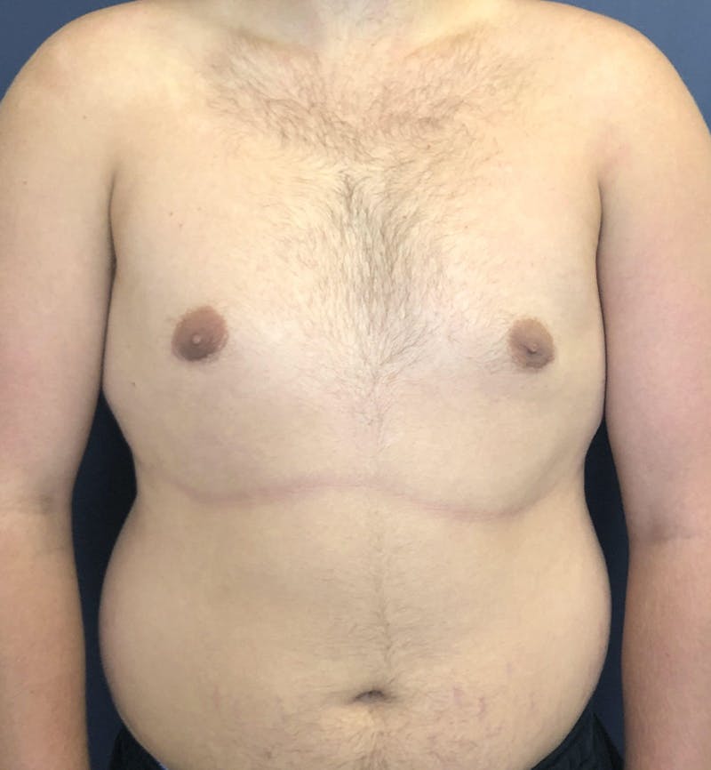 Male Breast Reduction Before & After Gallery - Patient 187852 - Image 2