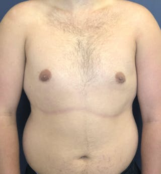 Male Breast Reduction Before & After Gallery - Patient 187852 - Image 2
