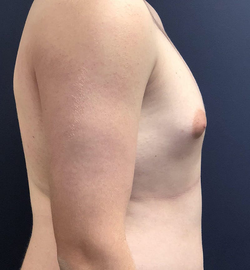 Male Breast Reduction Before & After Gallery - Patient 187852 - Image 3