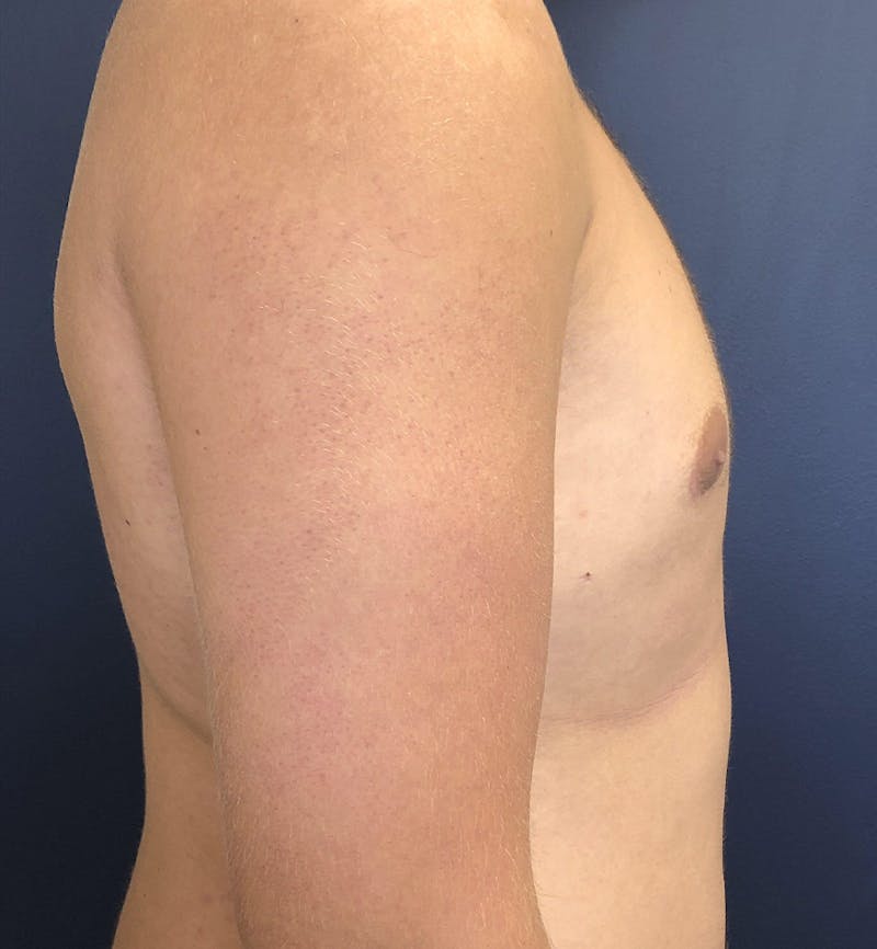 Male Breast Reduction Before & After Gallery - Patient 187852 - Image 4