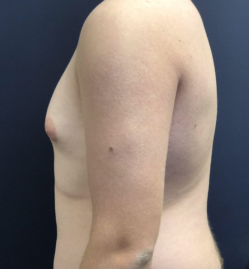 Male Breast Reduction Before & After Gallery - Patient 187852 - Image 5