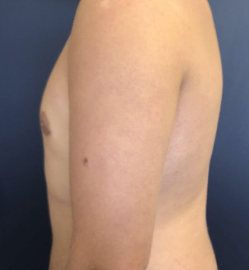 Male Breast Reduction Before & After Gallery - Patient 187852 - Image 6