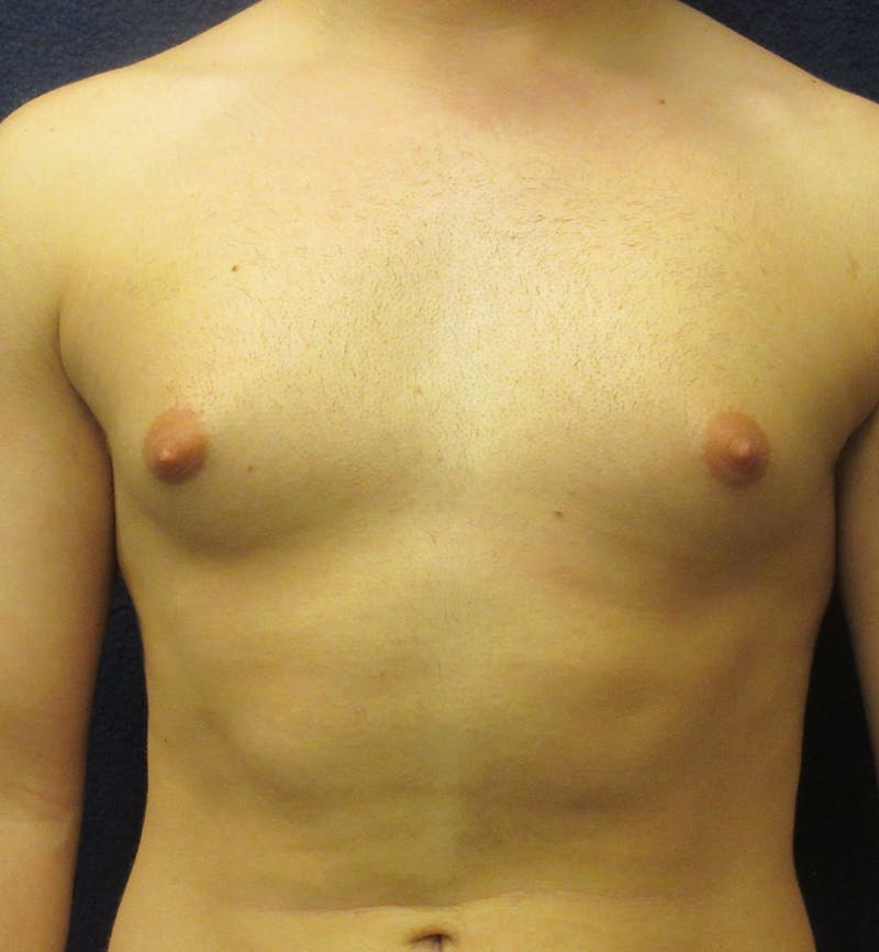 Male Breast Reduction Before & After Gallery - Patient 378137 - Image 1