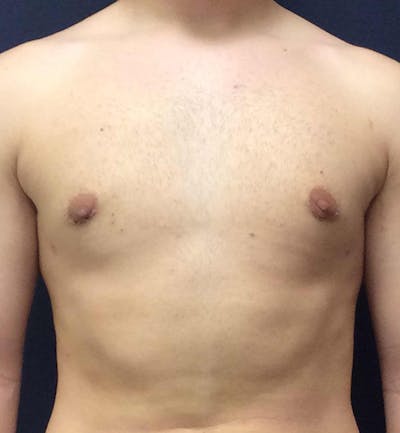 Male Breast Reduction Before & After Gallery - Patient 378137 - Image 2