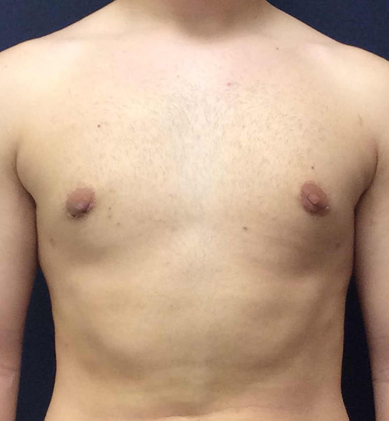 Male Breast Reduction Before & After Gallery - Patient 378137 - Image 2