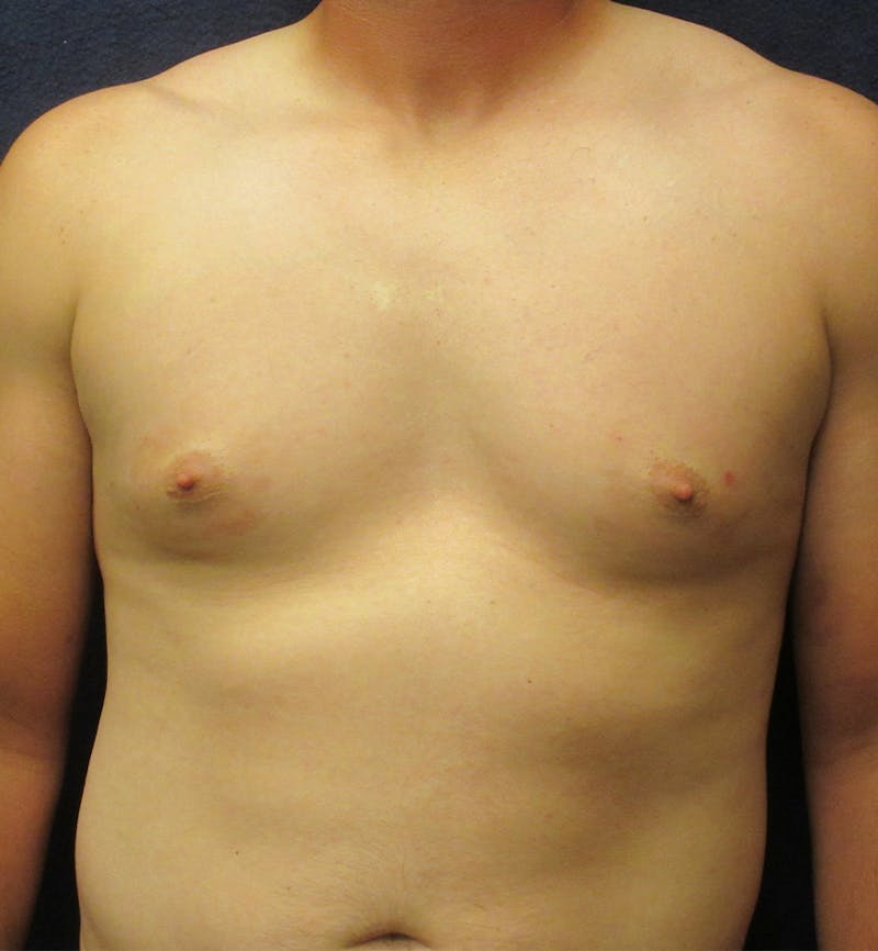 Male Breast Reduction Before & After Gallery - Patient 417664 - Image 1