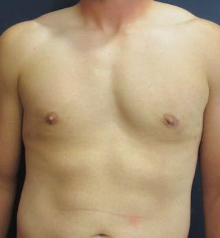 Male Breast Reduction Before & After Gallery - Patient 417664 - Image 2