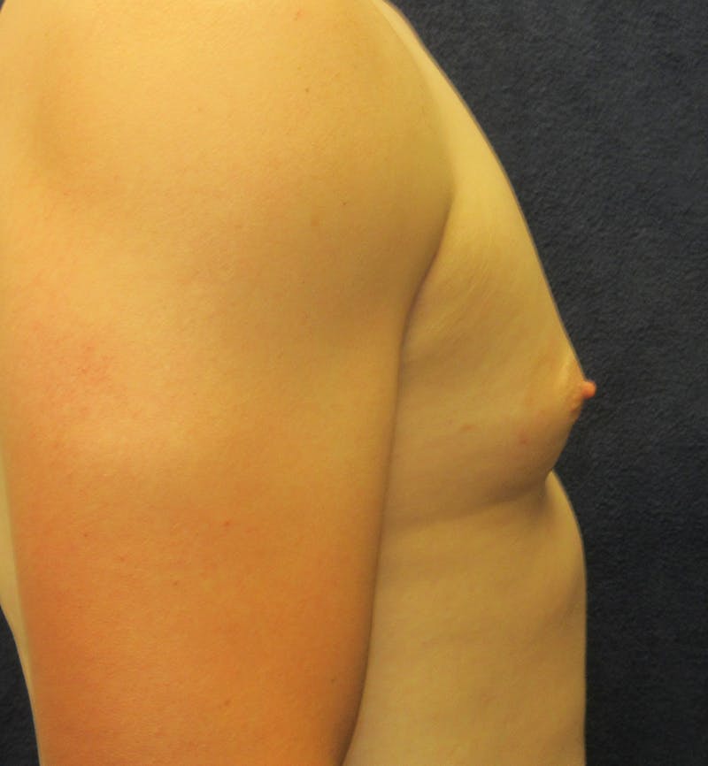 Male Breast Reduction Before & After Gallery - Patient 417664 - Image 3