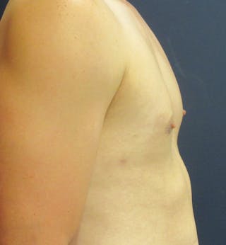 Male Breast Reduction Before & After Gallery - Patient 417664 - Image 4