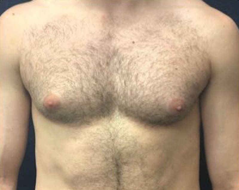 Male Breast Reduction Before & After Gallery - Patient 398399 - Image 1