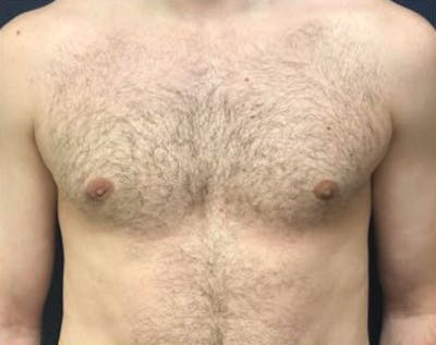 Male Breast Reduction Before & After Gallery - Patient 398399 - Image 2
