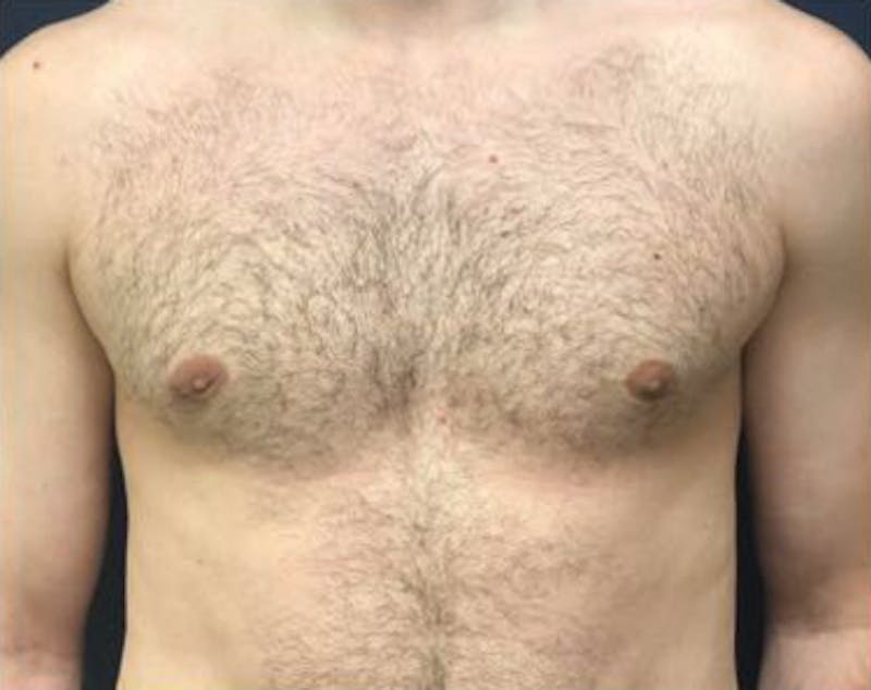 Male Breast Reduction Before & After Gallery - Patient 398399 - Image 2
