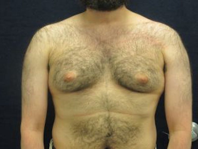 Male Breast Reduction Before & After Gallery - Patient 235414 - Image 1