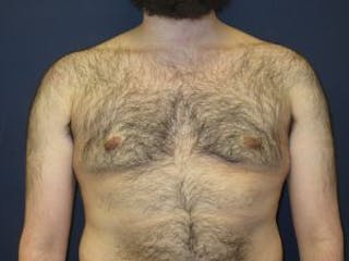 Male Breast Reduction Before & After Gallery - Patient 235414 - Image 2