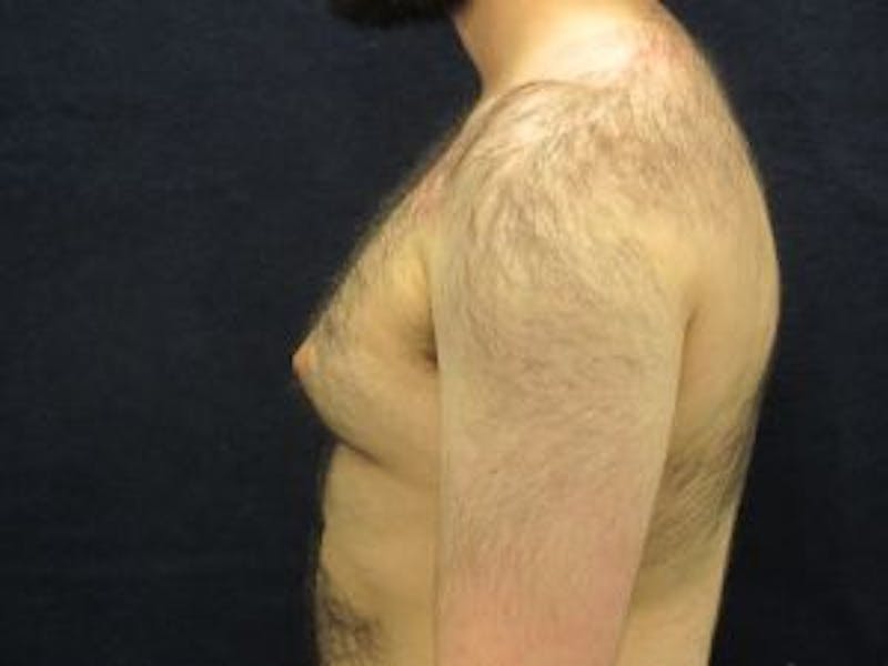 Male Breast Reduction Before & After Gallery - Patient 235414 - Image 3
