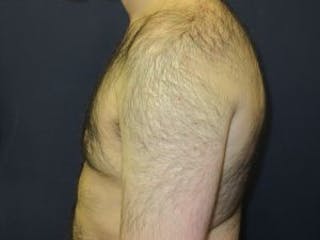 Male Breast Reduction Before & After Gallery - Patient 235414 - Image 4