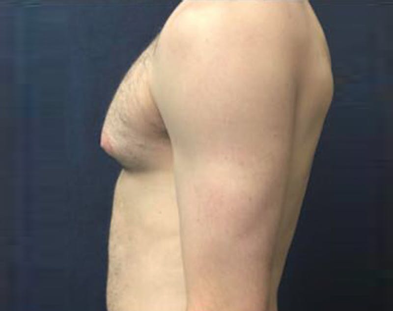 Male Breast Reduction Before & After Gallery - Patient 365462 - Image 1