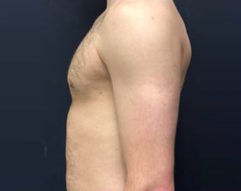 Male Breast Reduction Before & After Gallery - Patient 365462 - Image 2