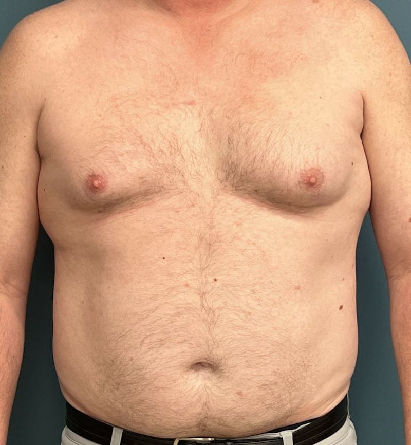 Male Breast Reduction Before & After Gallery - Patient 223068 - Image 1