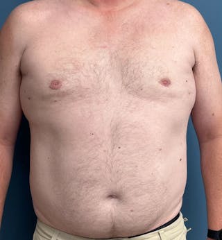 Male Breast Reduction Before & After Gallery - Patient 223068 - Image 2