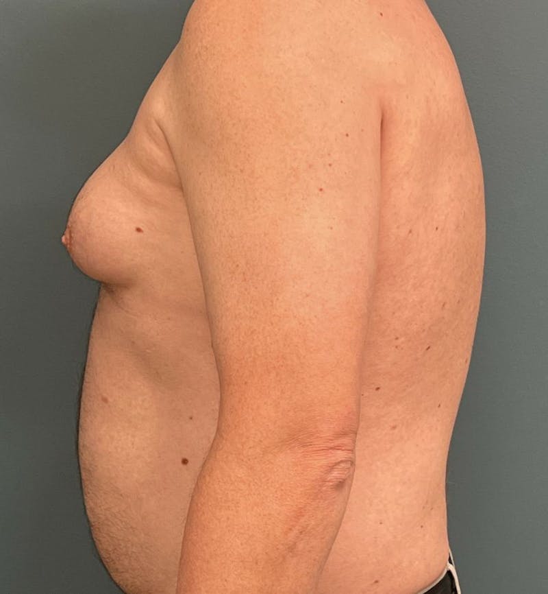 Male Breast Reduction Before & After Gallery - Patient 223068 - Image 3