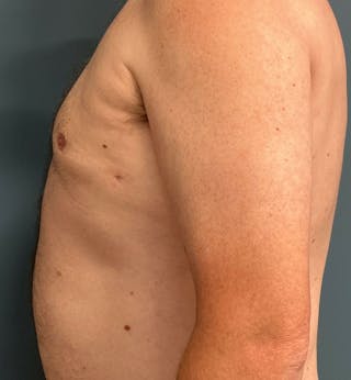 Male Breast Reduction Before & After Gallery - Patient 223068 - Image 4