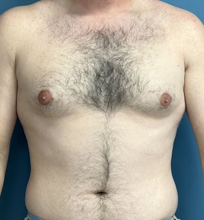 Male Breast Reduction Before & After Gallery - Patient 313426 - Image 1