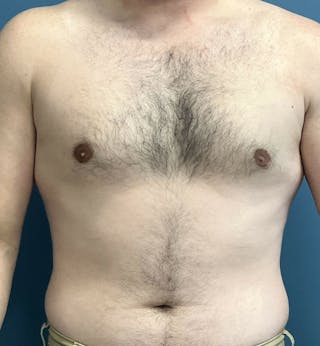 Male Breast Reduction Before & After Gallery - Patient 313426 - Image 2