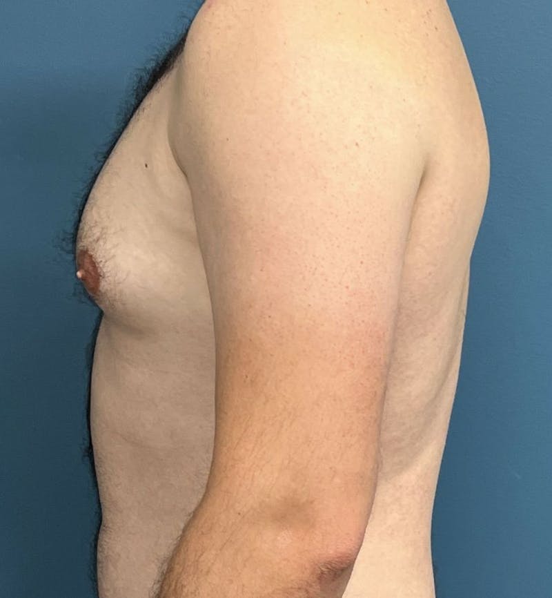 Male Breast Reduction Before & After Gallery - Patient 313426 - Image 3