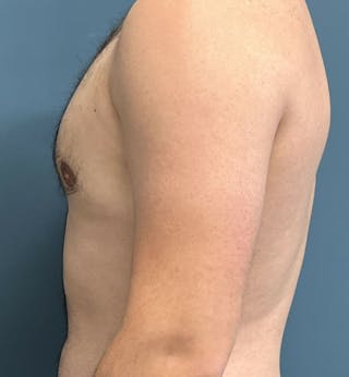 Male Breast Reduction Before & After Gallery - Patient 313426 - Image 4