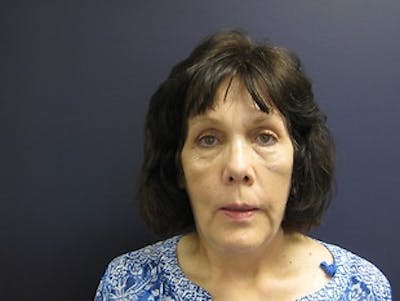 Brow Lift Before & After Gallery - Patient 403191 - Image 2