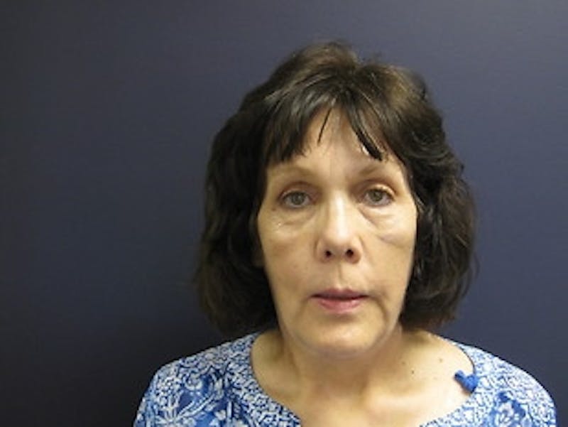 Brow Lift Before & After Gallery - Patient 403191 - Image 2