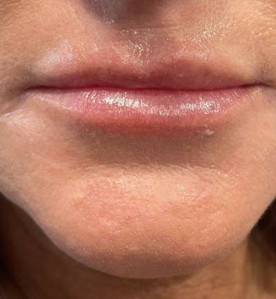 Dermal Fillers & Botox Before & After Gallery - Patient 185090 - Image 1