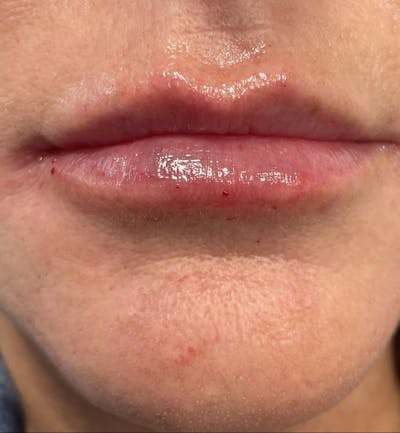 Dermal Fillers & Botox Before & After Gallery - Patient 185090 - Image 2