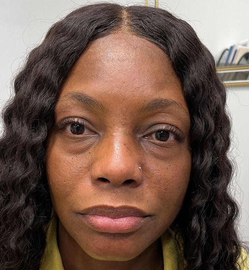 Dermal Fillers & Botox Before & After Gallery - Patient 388289 - Image 1