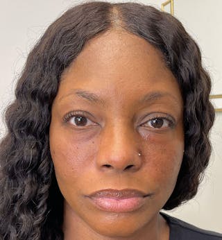 Dermal Fillers & Botox Before & After Gallery - Patient 388289 - Image 2