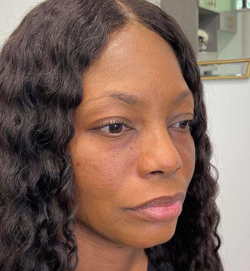 Dermal Fillers & Botox Before & After Gallery - Patient 388289 - Image 4
