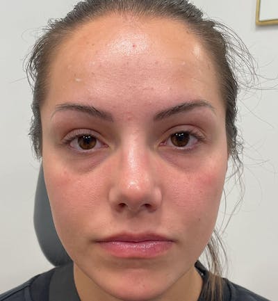 Dermal Fillers & Botox Before & After Gallery - Patient 287708 - Image 1