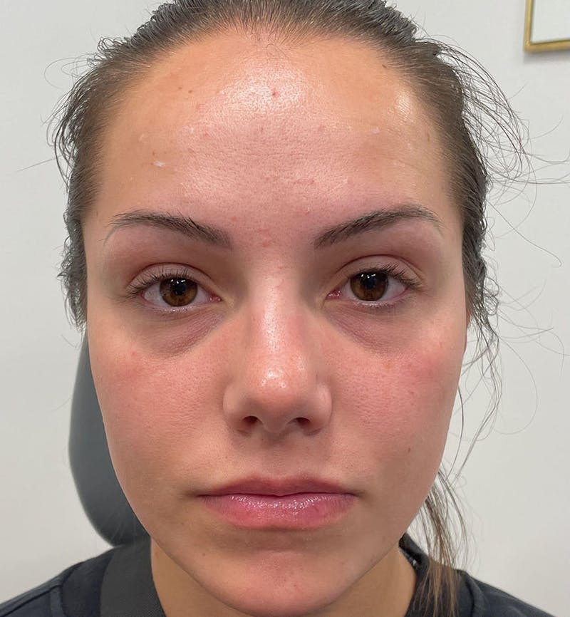 Dermal Fillers & Botox Before & After Gallery - Patient 287708 - Image 1