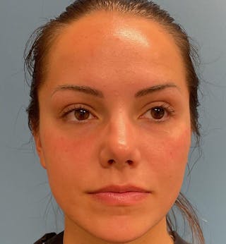 Dermal Fillers & Botox Before & After Gallery - Patient 287708 - Image 2