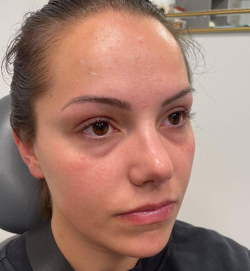 Dermal Fillers & Botox Before & After Gallery - Patient 287708 - Image 3