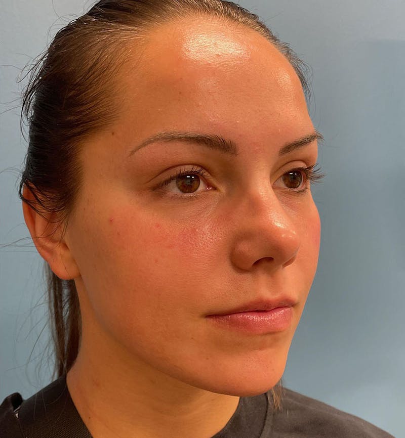 Dermal Fillers & Botox Before & After Gallery - Patient 287708 - Image 4