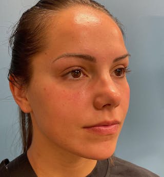 Dermal Fillers & Botox Before & After Gallery - Patient 287708 - Image 4