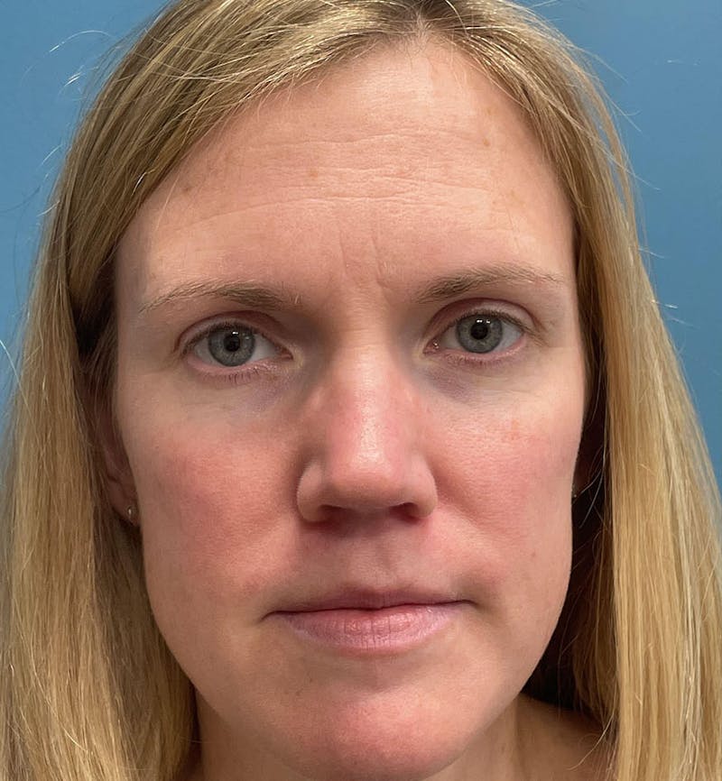 Dermal Fillers & Botox Before & After Gallery - Patient 259208 - Image 1