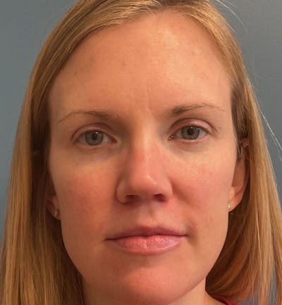 Dermal Fillers & Botox Before & After Gallery - Patient 259208 - Image 2