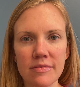 Dermal Fillers & Botox Before & After Gallery - Patient 259208 - Image 2